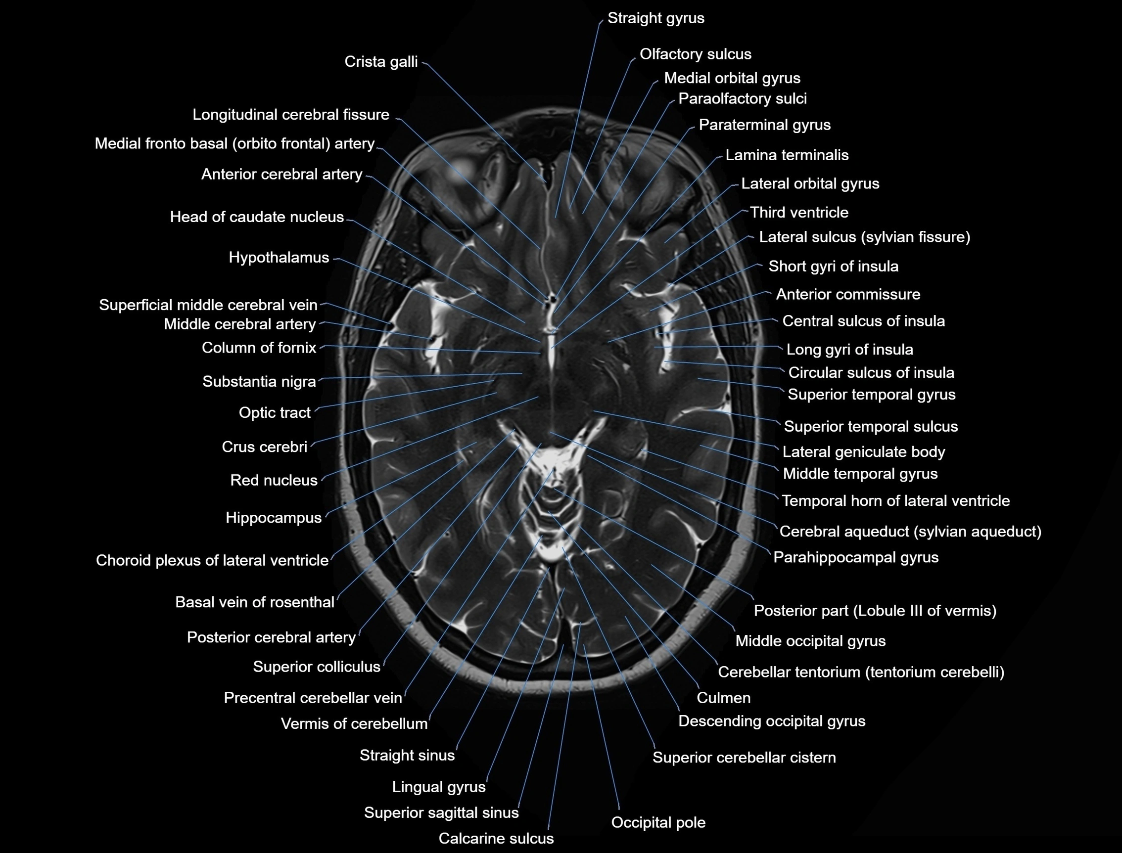 MRI Brain axial cross sectional radiology anatomy 3T image  -img-00001-00025.webp